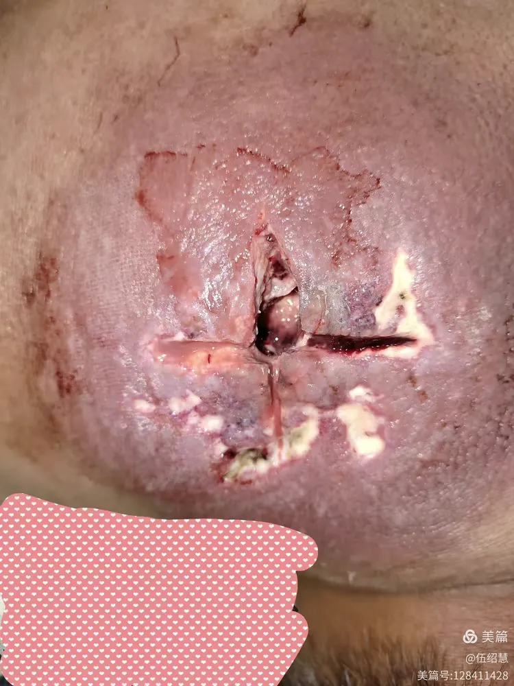 1例2型糖尿病并背部巨大痈